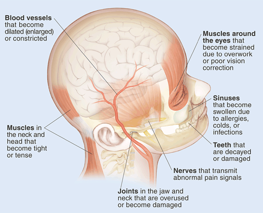 Understanding Headache Pain Saint Luke S Health System