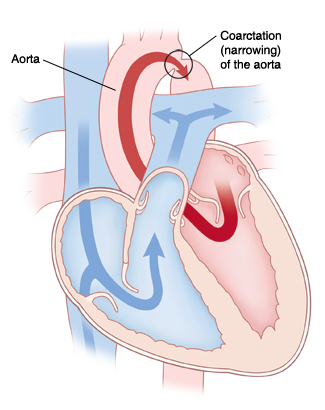 Vista de las cuatro cavidades en un corazón con coartación de la aorta. Las flechas indican el flujo de sangre restringido en la aorta.