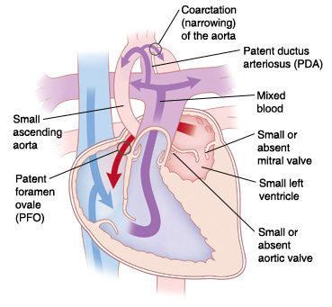 Congenital Heart Defects - Facts about Coarctation of the Aorta