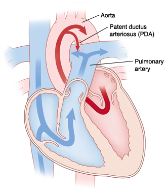 Vista frontal en sección transversal de un corazón con conducto arterial persistente. Las flechas indican la sangre que fluye a través del conducto arterial persistente.