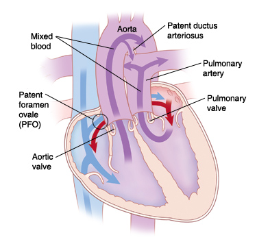 Vista de las cuatro cavidades en un corazón con transposición de las grandes arterias. Las flechas indican el flujo de sangre a través del corazón.