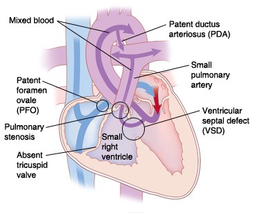 Vista de las cuatro cavidades en un corazón con atresia tricuspídea. Las flechas indican que la sangre no puede fluir de la aurícula derecha al ventrículo derecho.