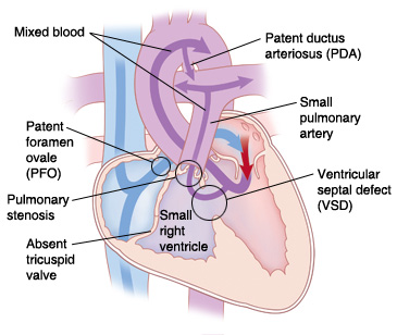 radiografía de atresia tricuspídea