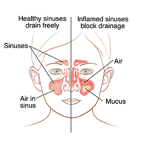 Vista frontal de la cara de un niño que muestra la anatomía de los senos paranasales normales de un lado y de los senos paranasales inflamados del otro.
