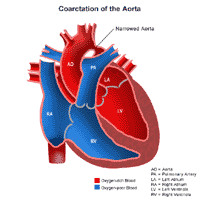 Coarctation of the Aorta Heart Anatomy