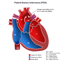 Patent ductus arteriosus anatomy