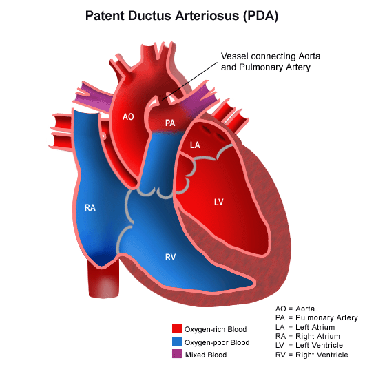 Congenital Heart Disease & Defects in Children | St. Louis