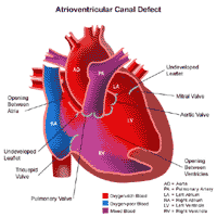 Atrioventricular cCnal Defect Heart Anatomy