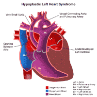 Hypoplastic Left Heart Syndrome Heart Anatomy