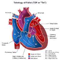 Tetralogy of Fallot Heart Anatomy