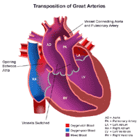 Transposition of the Great Arteries Heart Anatomy