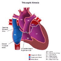 Tricuspid Atresia Heart Condition