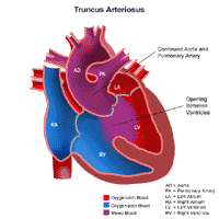 Truncus Arteriosus Heart Anatomy