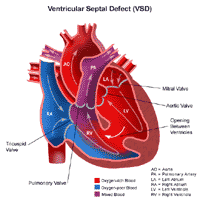 Ventricular Septal Defect Heart Anatomy