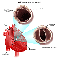 Aortic Stenosis Heart Anatomy