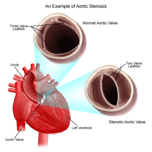 Congenital Heart Disease & Defects in Children