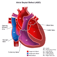 Atrial Septal Defect Anatomy