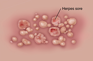 Genital symptoms herpes Genital Herpes