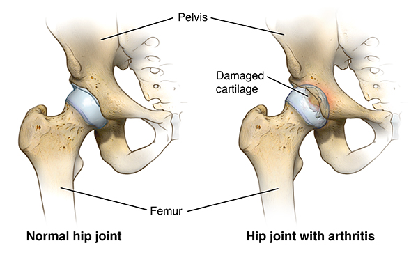 Hip Replacement Surgery A Woman S View Healthcare For Women Hickory Nc