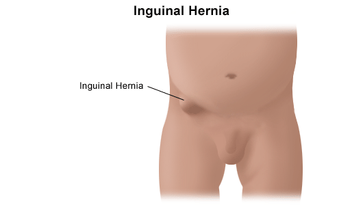 Hernia Umbilical And Inguinal A Woman S View Healthcare For Women Hickory Nc