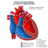 Haga clic en la imagen para ampliarla. Ilustración de la anatomía de un corazón con conducto arterial persistente