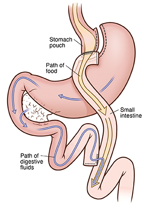Front view of stomach showing Roux-en-Y gastric bypass. Arrows show path of food and digestive fluids.