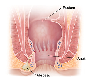 Cross section of anus showing abscess.