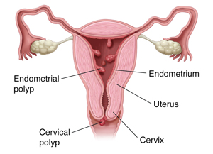 Cross section of uterus showing polyps inside and on cervix. 