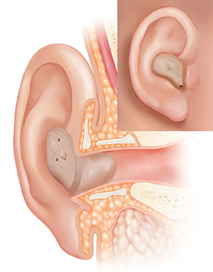 types of hearing aids for children