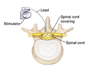 Lower back pain now treated by implantable nerve stimulation device -  UCHealth Today