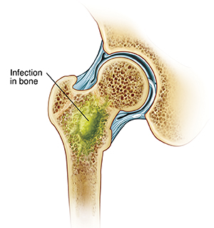 Front view cross section of hip joint showing infection in leg bone.
