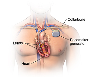 Overview Pacemakers and Cardioverter Defibrillators (ICDs) |