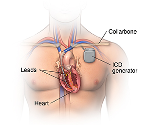 cardiac defibrillator