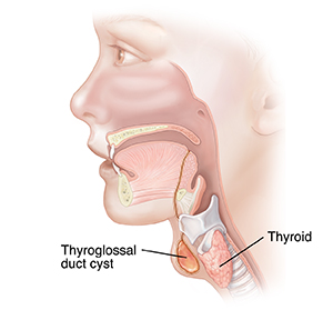 Side view of child's head and neck showing thyroglossal duct cyst.