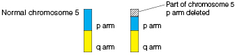 Graphic showing normal chromosome with p arm and q arm, compared to chromosome with part of p arm deleted.  