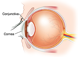 foreign body in eye