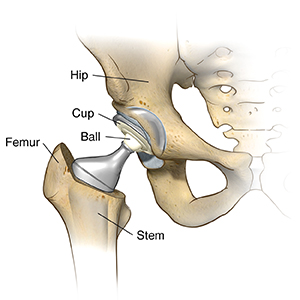 Joint Replacement Surgery