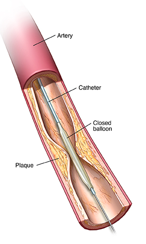 Can i get health insurance hot sale after angioplasty