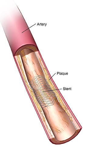 Angioplasty and stent placement - heart: MedlinePlus Medical