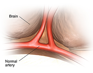 Closeup view of the brain showing  normal arteries.