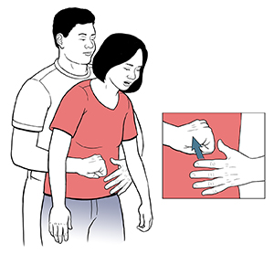 Choking and Abdominal Thrusts | University Hospitals