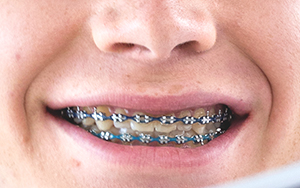 Aligners