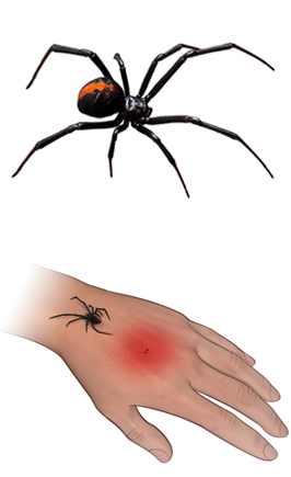 Black Widow spider and bite