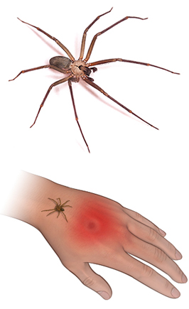 Brown Recluse spider and bite