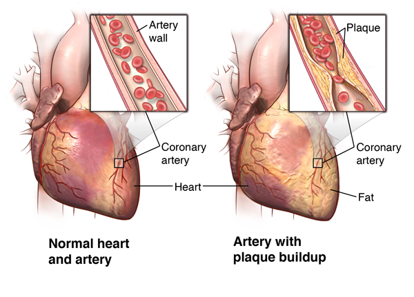 Preventing Plaque Buildup in the Arteries