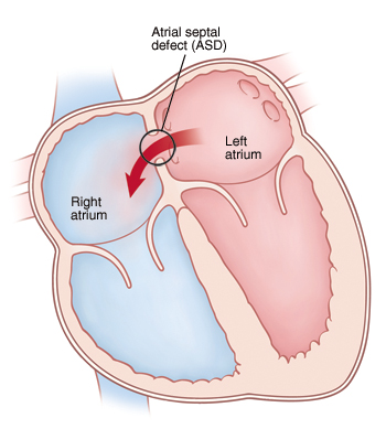 Front view cross section of heart showing atrial septal defect. Arrows indicate blood flowing through defect from left atrium to right atrium.