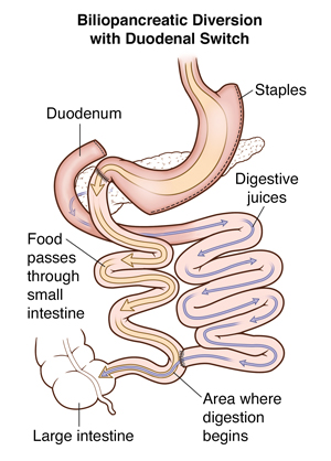 biliopancreatic diversion with duodenal switch bpd ds weight loss surgery university hospitals