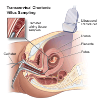 Illustration demonstrating a transcervical chorionic villus sampling