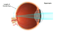 Illustration demonstrating hyperopia