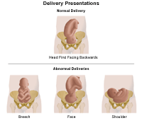 Illustration demonstrating normal delivery, and abnormal delivery presentations